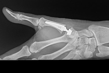 Thumb CMCJ Replacment X-ray.jpg