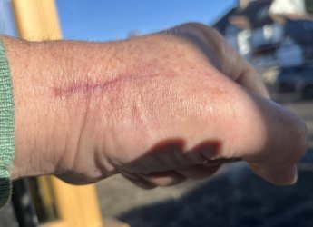 Scar seven weeks in.jpg